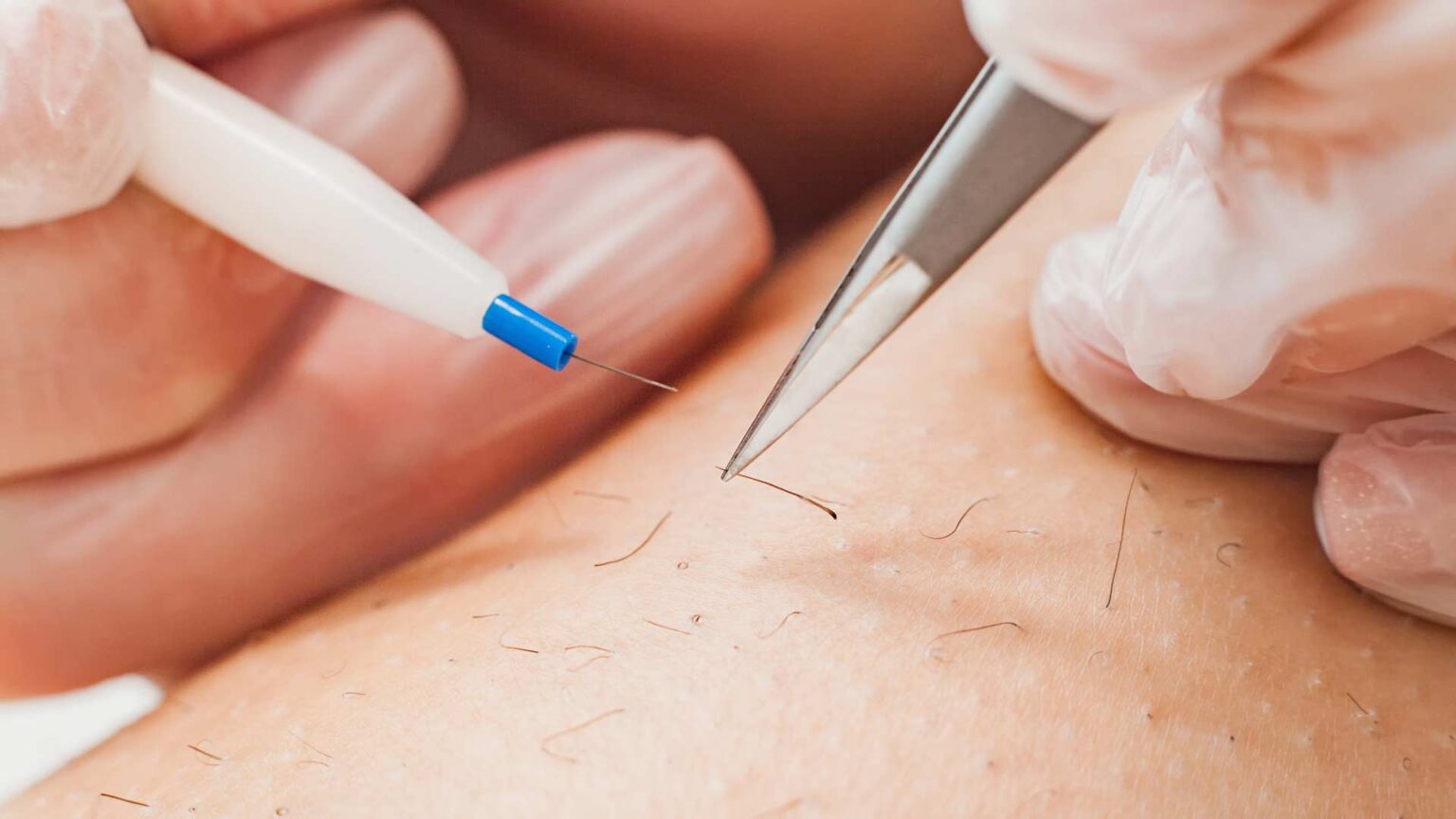 Electrolysis permanent hair removal — alternative to laser and waxing — at Refined Comfort Aesthetics, New Braunfels TX
