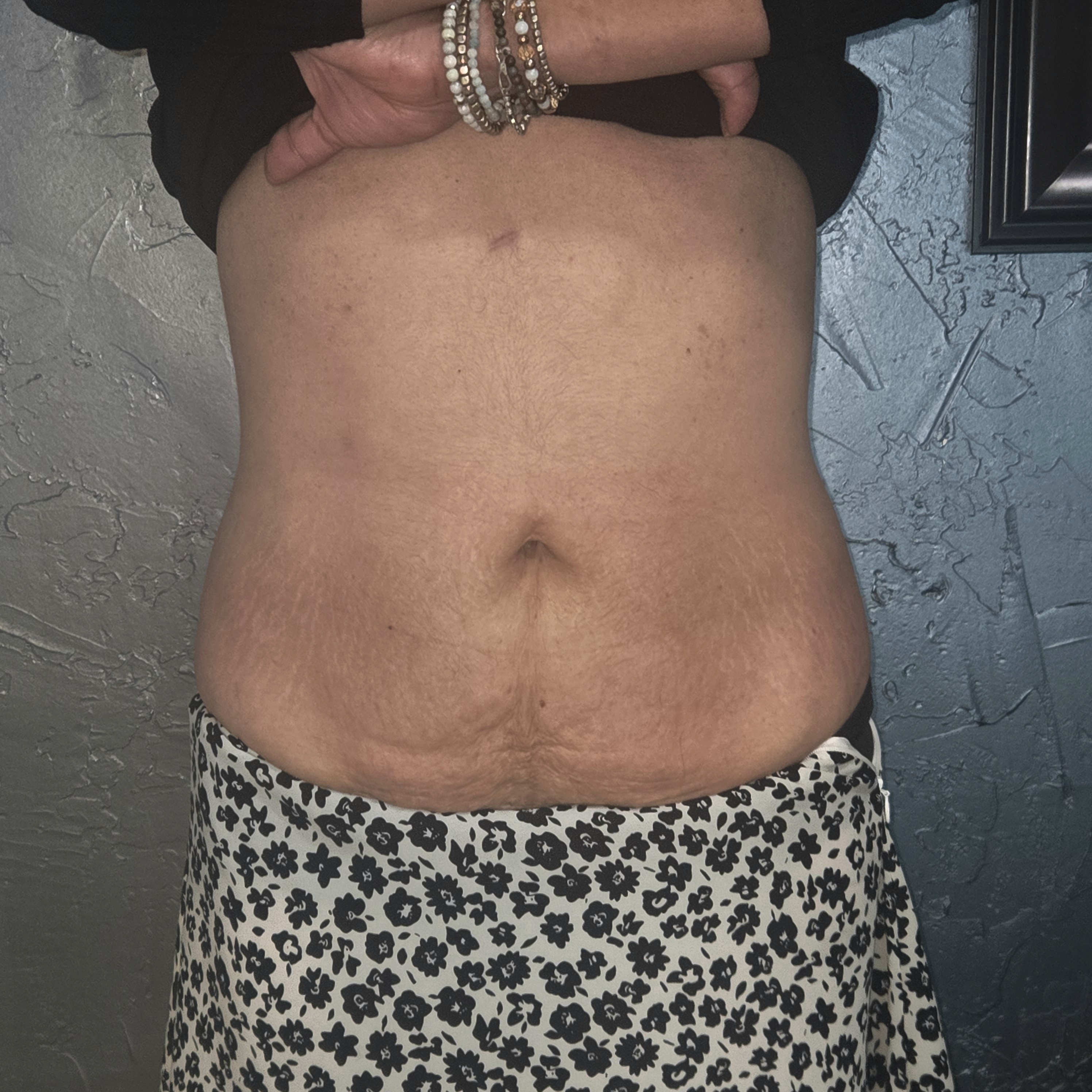 Ultrasonic cavitation and RF body contouring — after treatment results, Refined Comfort Aesthetics New Braunfels TX