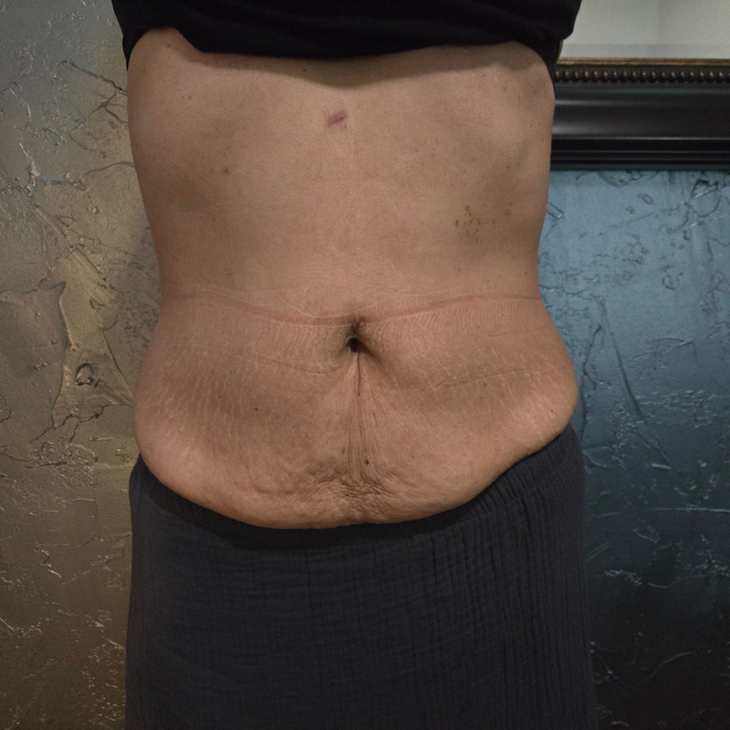 Ultrasonic cavitation and RF body contouring — before treatment, Refined Comfort Aesthetics New Braunfels TX
